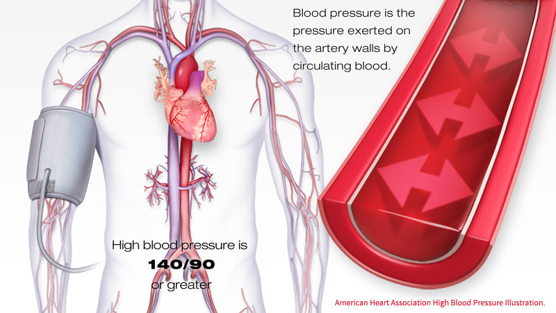 Arterial Hypertension (High Blood Pressure)
