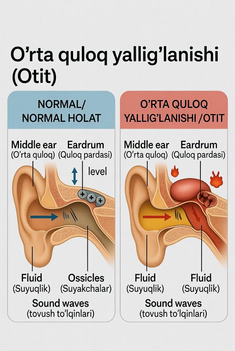 O‘rta quloq yallig‘lanishi (Otit)