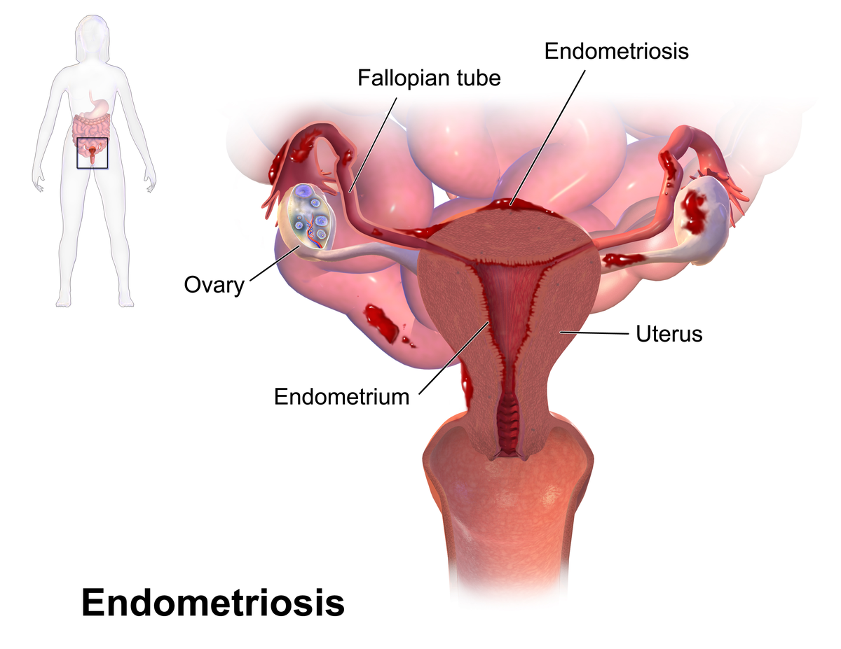 Endometrioz