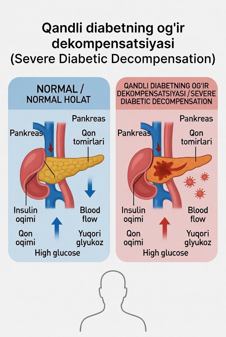 Qandli diabetning og‘ir dekompensatsiyasi