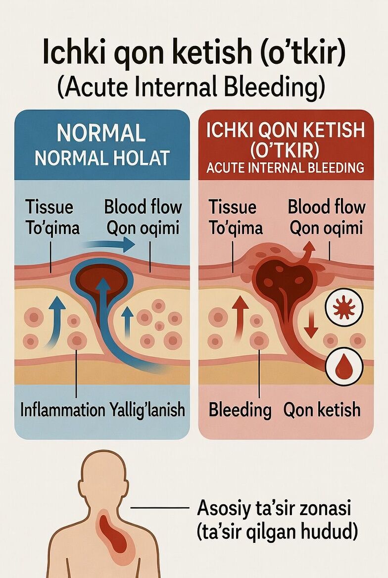 Ichki qon ketish (o‘tkir)