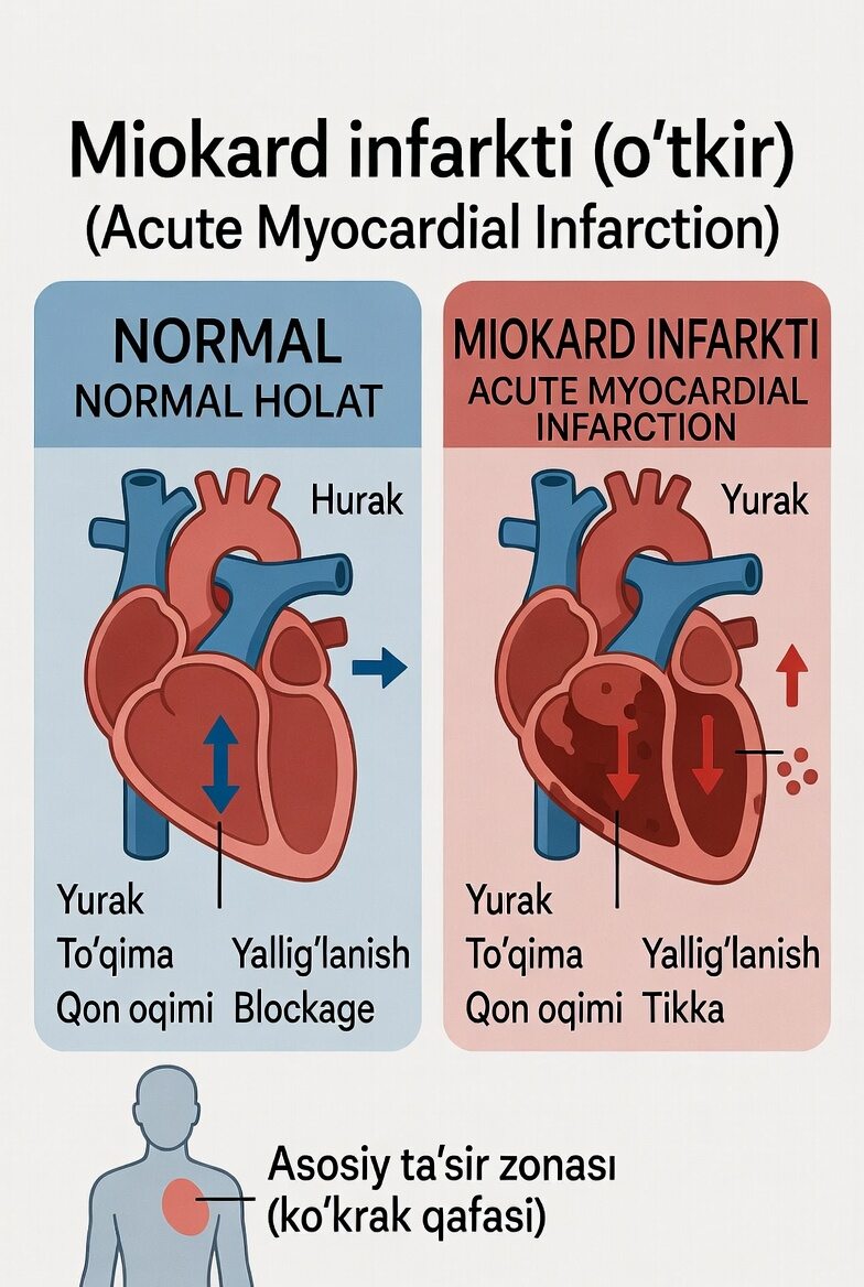 Miokard infarkti (o‘tkir)