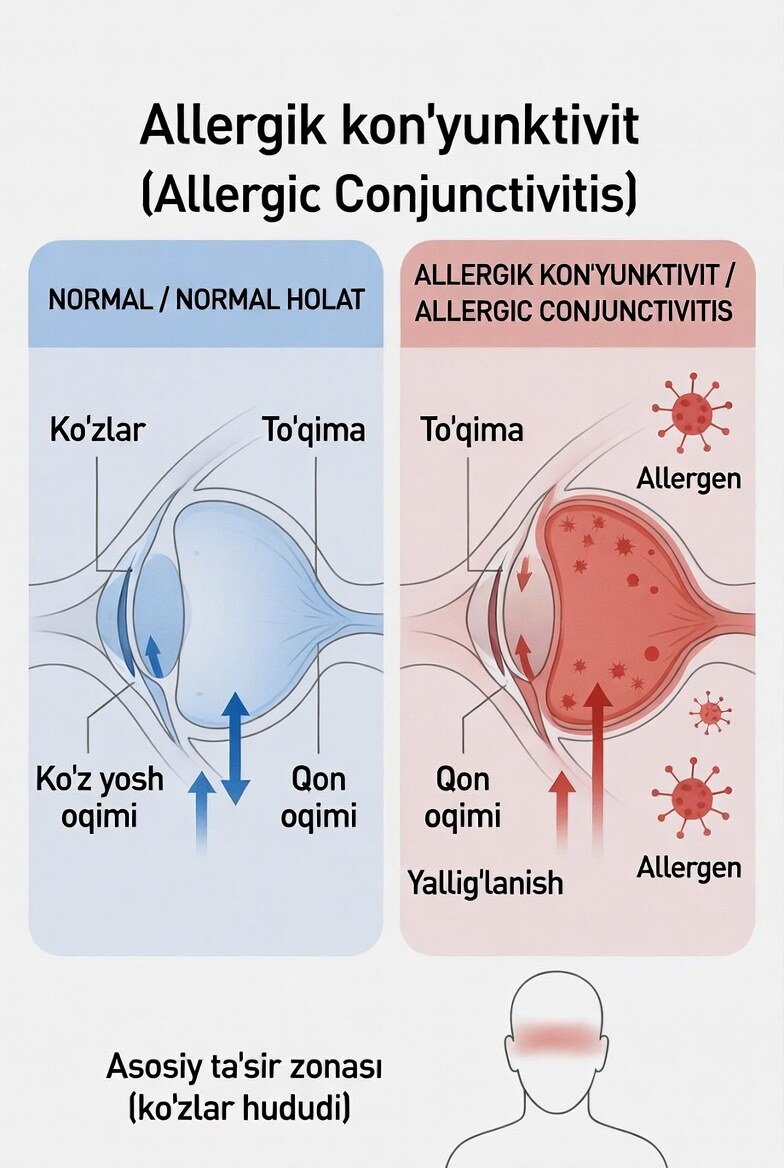 Allergic Conjunctivitis