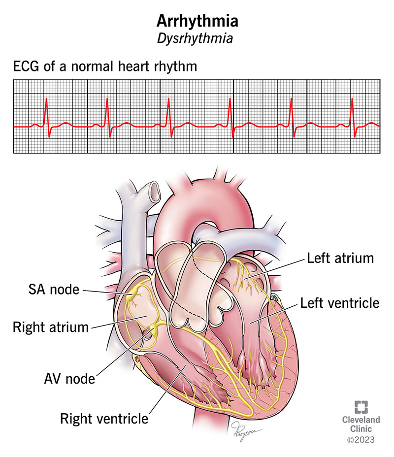 Heart Rhythm Disorders (Arrhythmias)