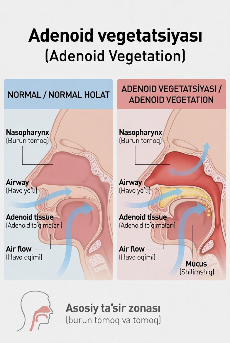 Adenoid vegetatsiyasi