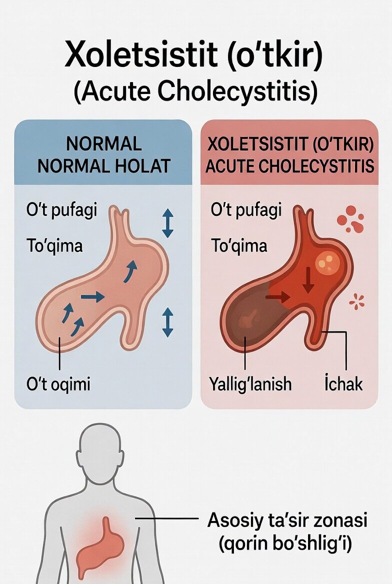 Xoletsistit (o‘tkir)