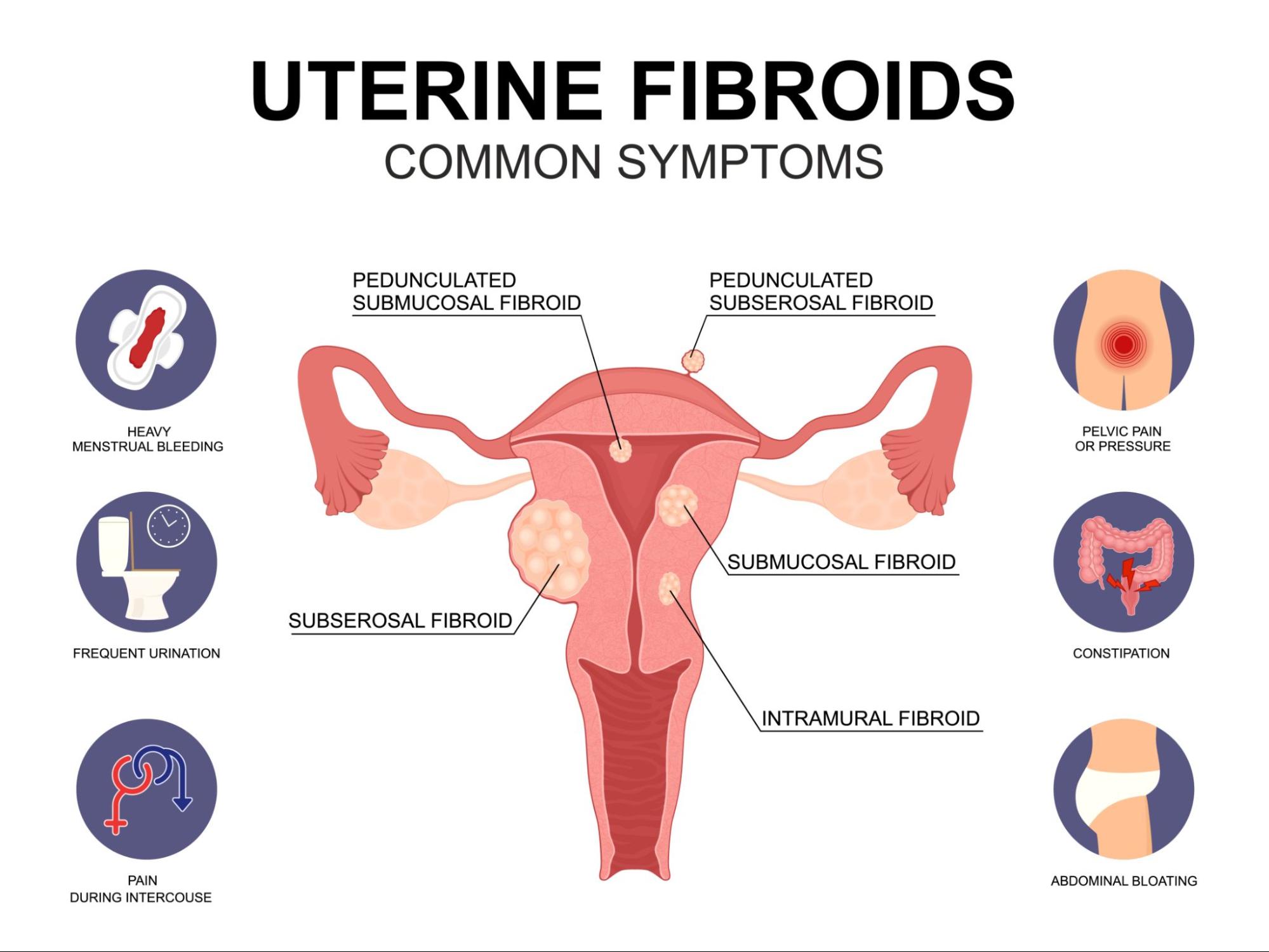 Uterine Fibroids