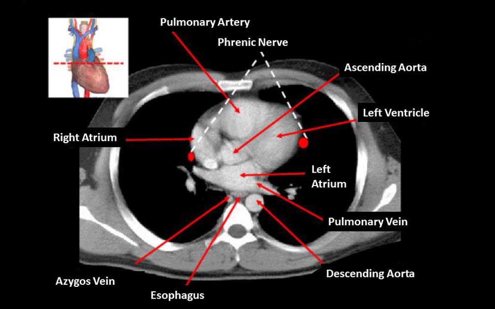 Chest CT Scan (Lung Computed Tomography)