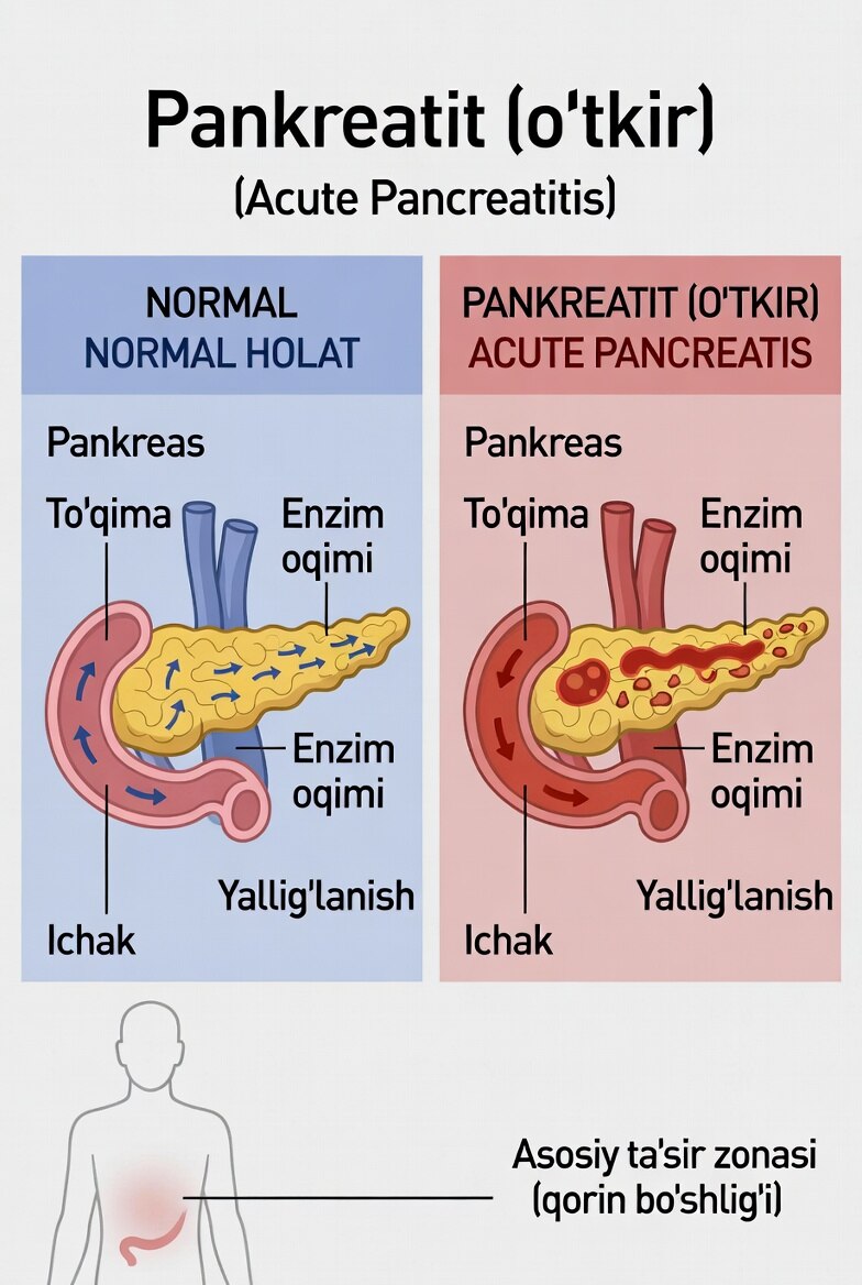Pankreatit (o‘tkir)