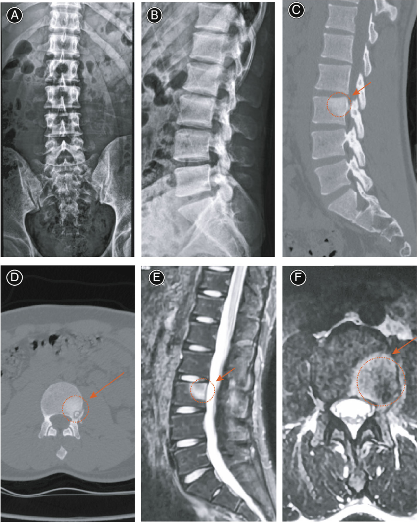 Orqa umurtqa holatini ko‘rish (rentgen / KT orqali)