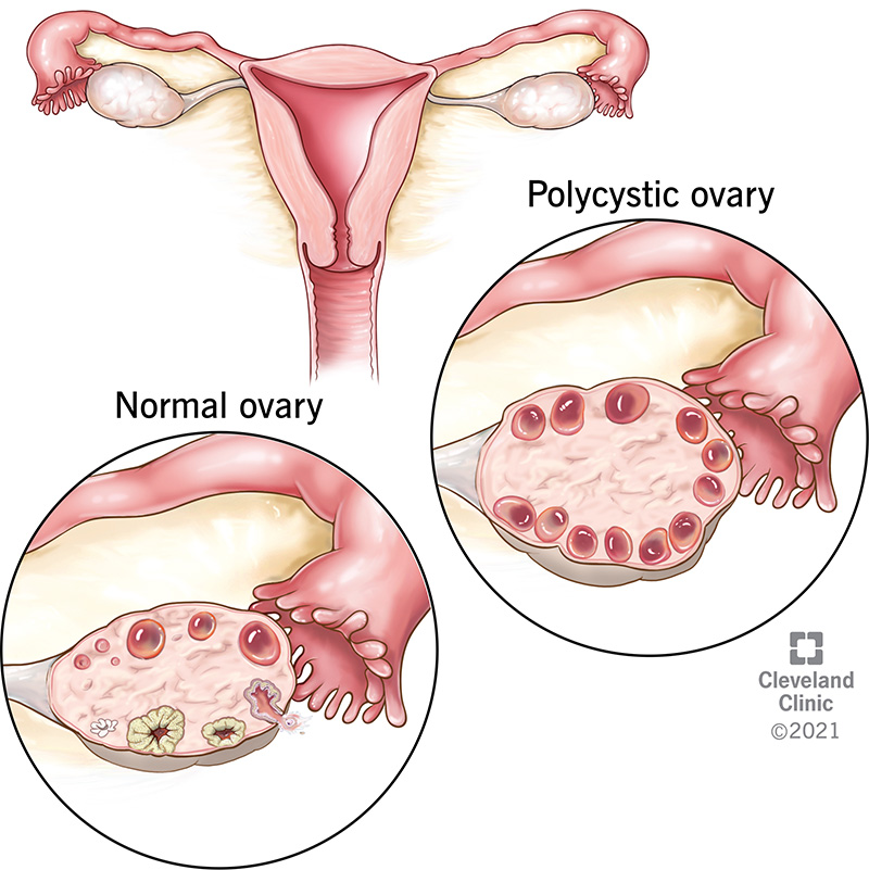 Polycystic Ovary Syndrome (PCOS)