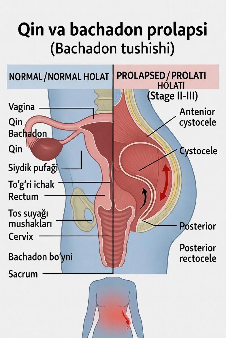 Qin va bachadon prolapsi (Bachadon tushishi)