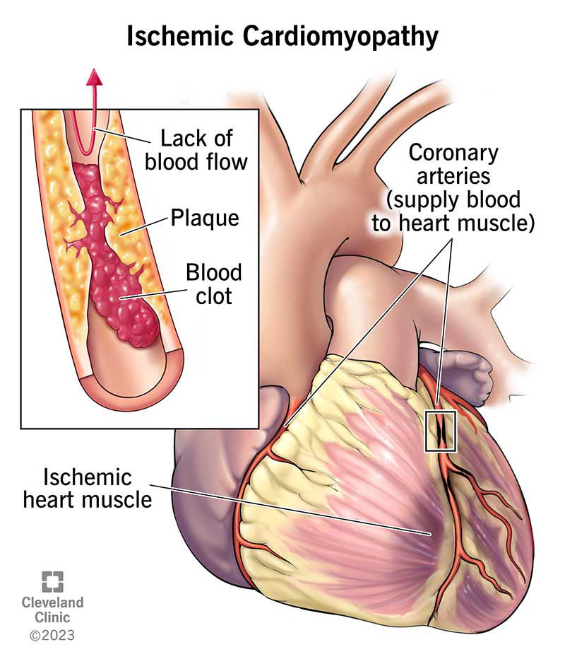 Ischemic Heart Disease
