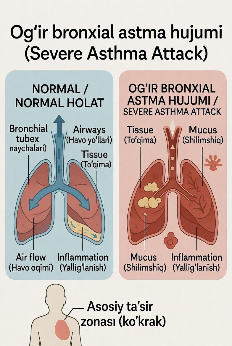 Og‘ir bronxial astma hujumi