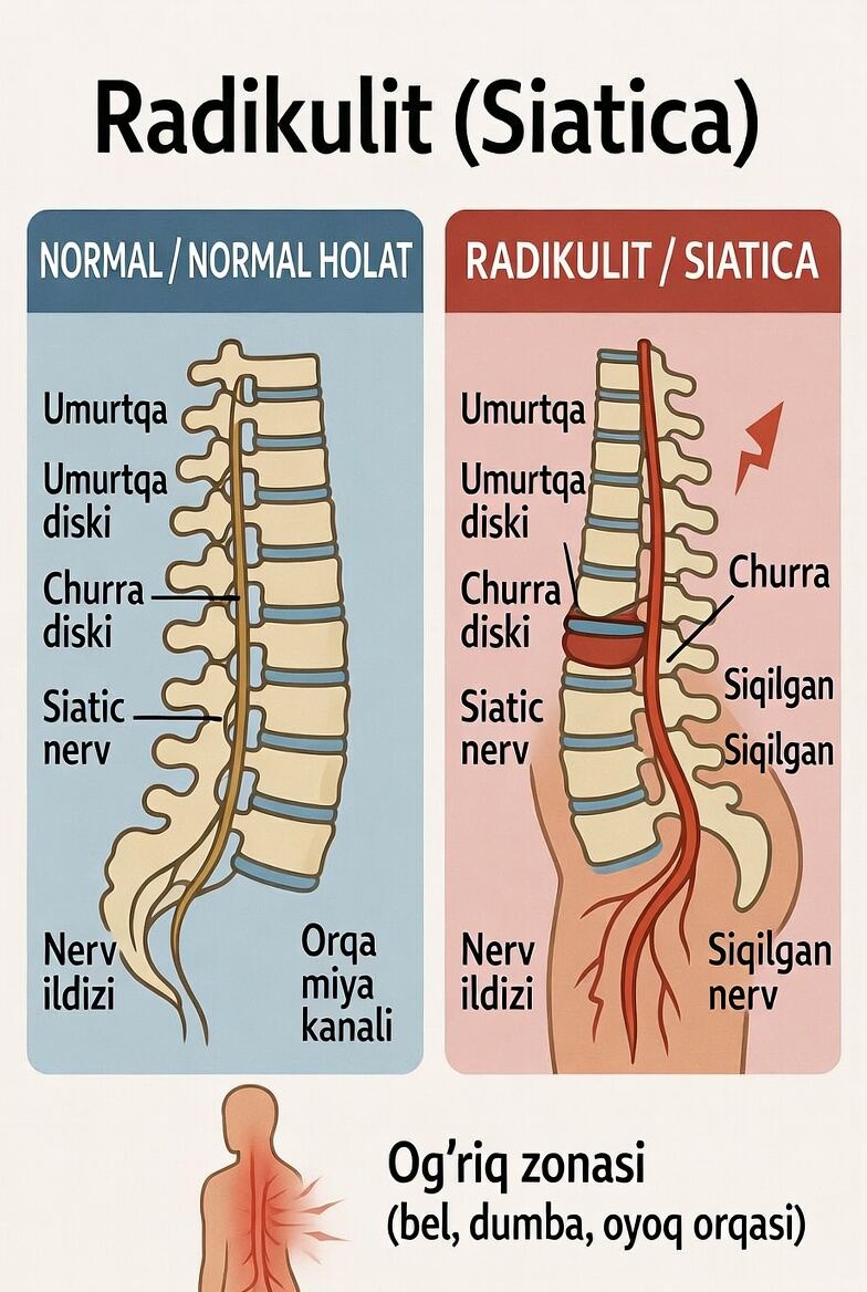 Radikulit (Siatica)