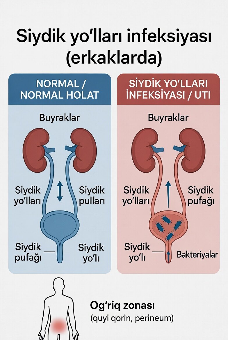 Siydik yo‘llari infeksiyasi (erkaklarda)