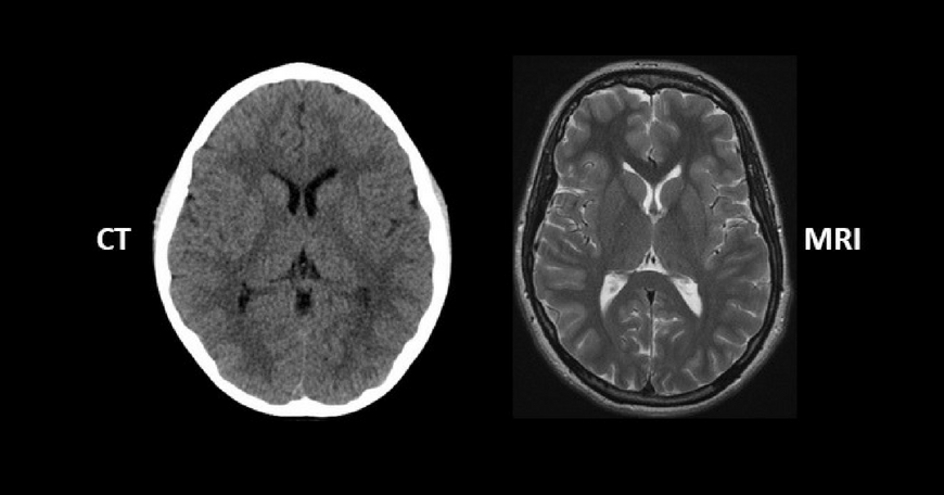 Brain Tomography (CT or MRI Scan)